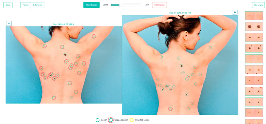 DermEngine Intelligent Dermatology Software and Total Body Photography