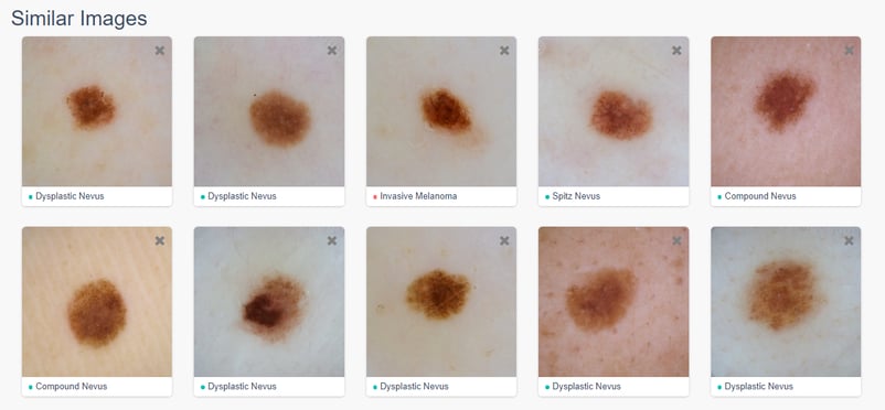 DermEngine Content Based Image Retrieval  in Artificial Intelligent Dermatology 
