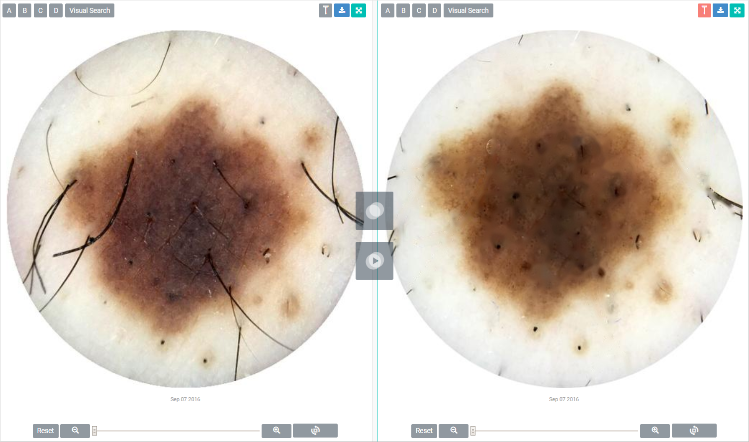 DermEngine Intelligent  Dermatology Software Razor Tool for Skin Analytics