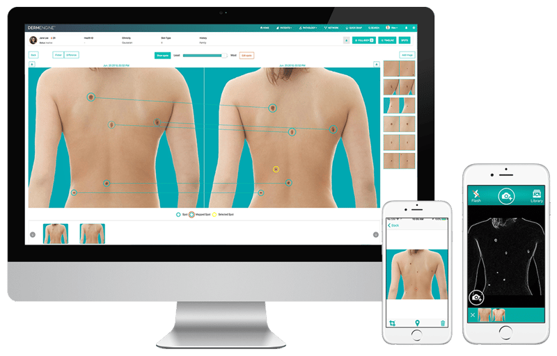 Total Body Photography (whole body screening) captures and analyzes full body images for lesion detection and the evaluation of new or changing moles