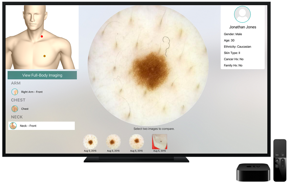 Intelligent Dermatology Software - Apple TV