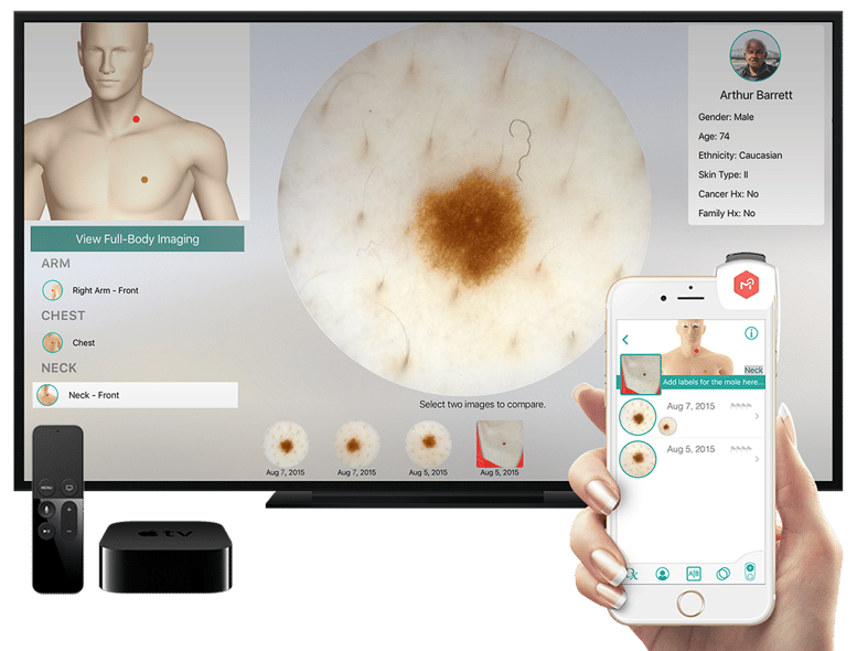Intelligent Dermatology Software - Apple TV
