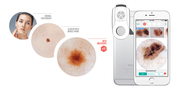 MoleScope - Mobile dermoscopy