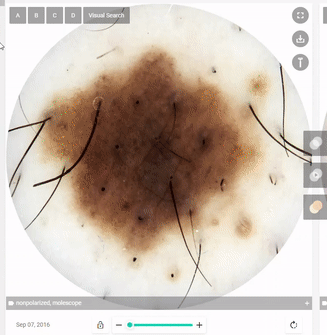 Digital Hair Removal Tool Dermoscopic Images AI DermEngine