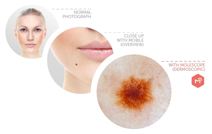 MoleScope dermoscopy high powered imaging