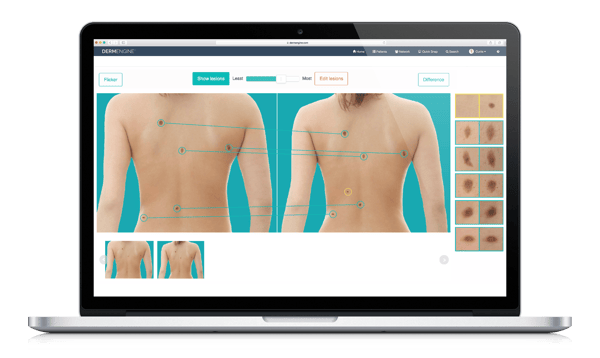 DermEngine total body photography  for skin cancer diagnosis support