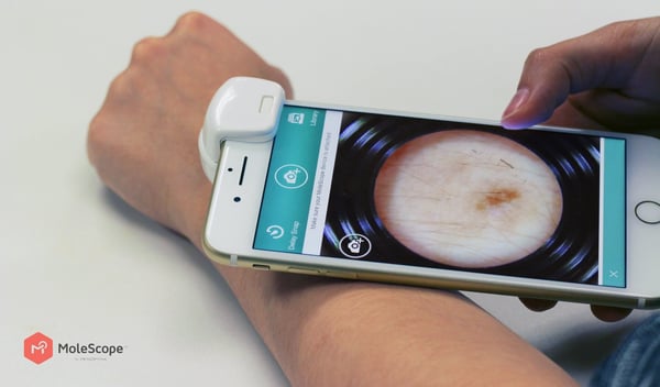 Mobile dermoscopes are empowering patients to perform own self-examinations