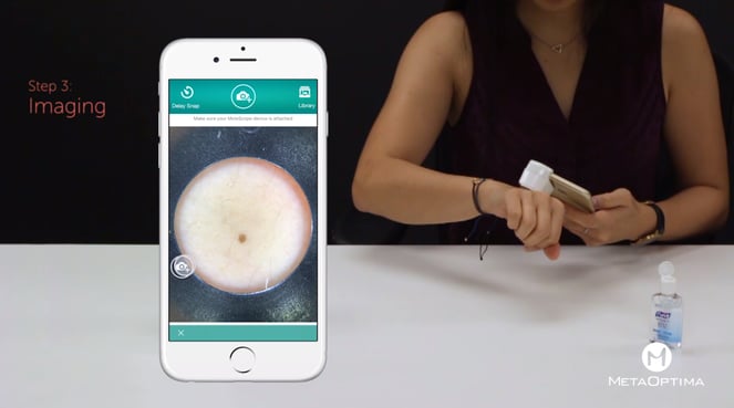 MoleScope mobile dermoscope is simply a digital dermoscope that attaches to a smartphone or tablet to take the images