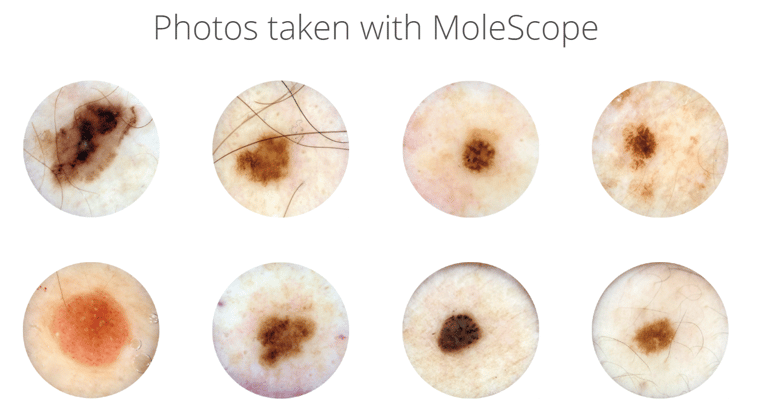 Photos taken with MoleScope (Mobile Dermatoscope)