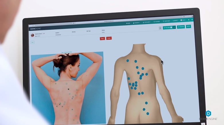 Total Body Photography Feature On DermEngine for MoleMapping