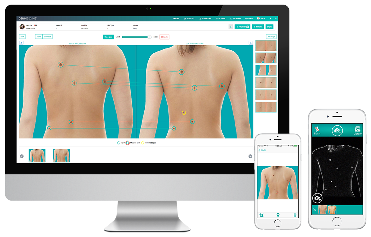 Total Body Photography (whole body screening) captures and analyzes full body images for lesion detection and the evaluation of new or changing moles