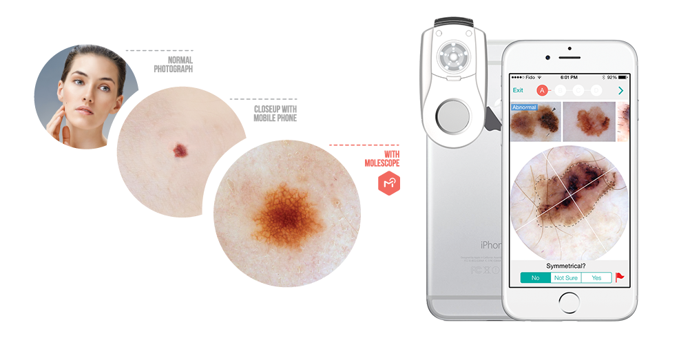 MoleScope - Seamless integration device for mobile dermoscopy