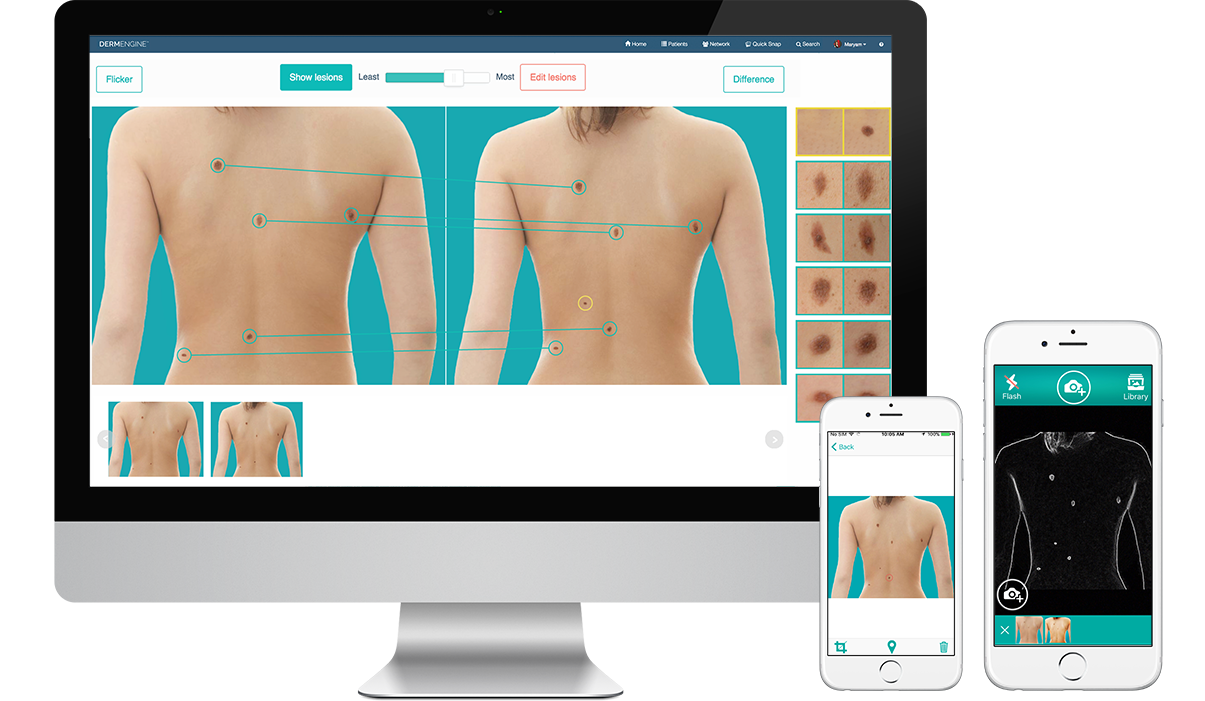 Total Body Photography (whole body screening) captures and analyzes full body images for lesion detection and the evaluation of new or changing moles